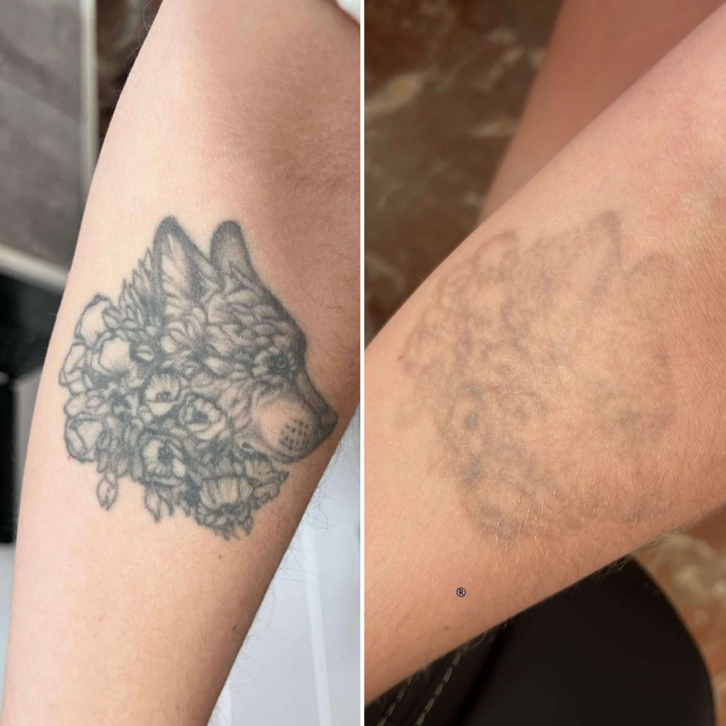 Imagen del proceso de aclaramiento de un cover up antes de un nuevo tatuaje