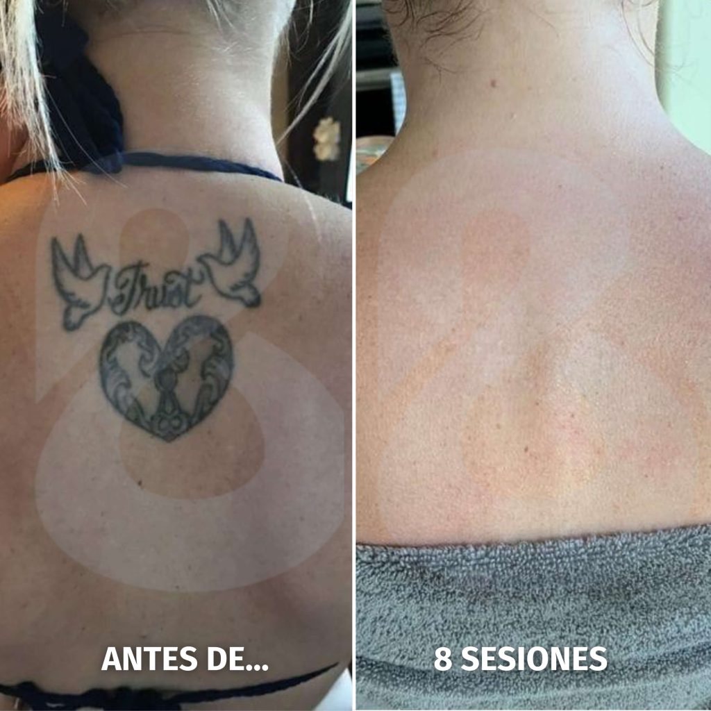 Imagen del proceso de aclaramiento de cover up en Benidorm