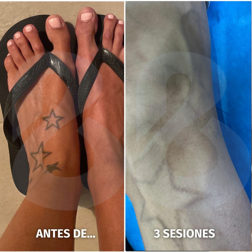 Proceso de aclaramiento previo a nuevo tatuaje en Benilaser