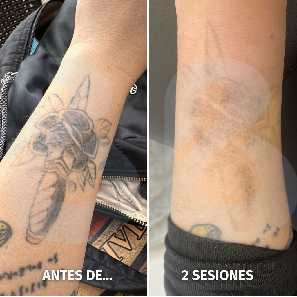 Imagen representativa de eliminación de tatuaje en Benilaser