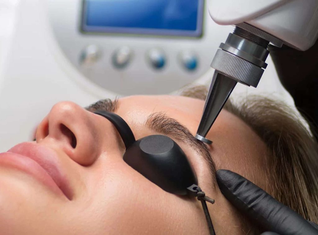 Tratamiento de eliminación de microblading con láser