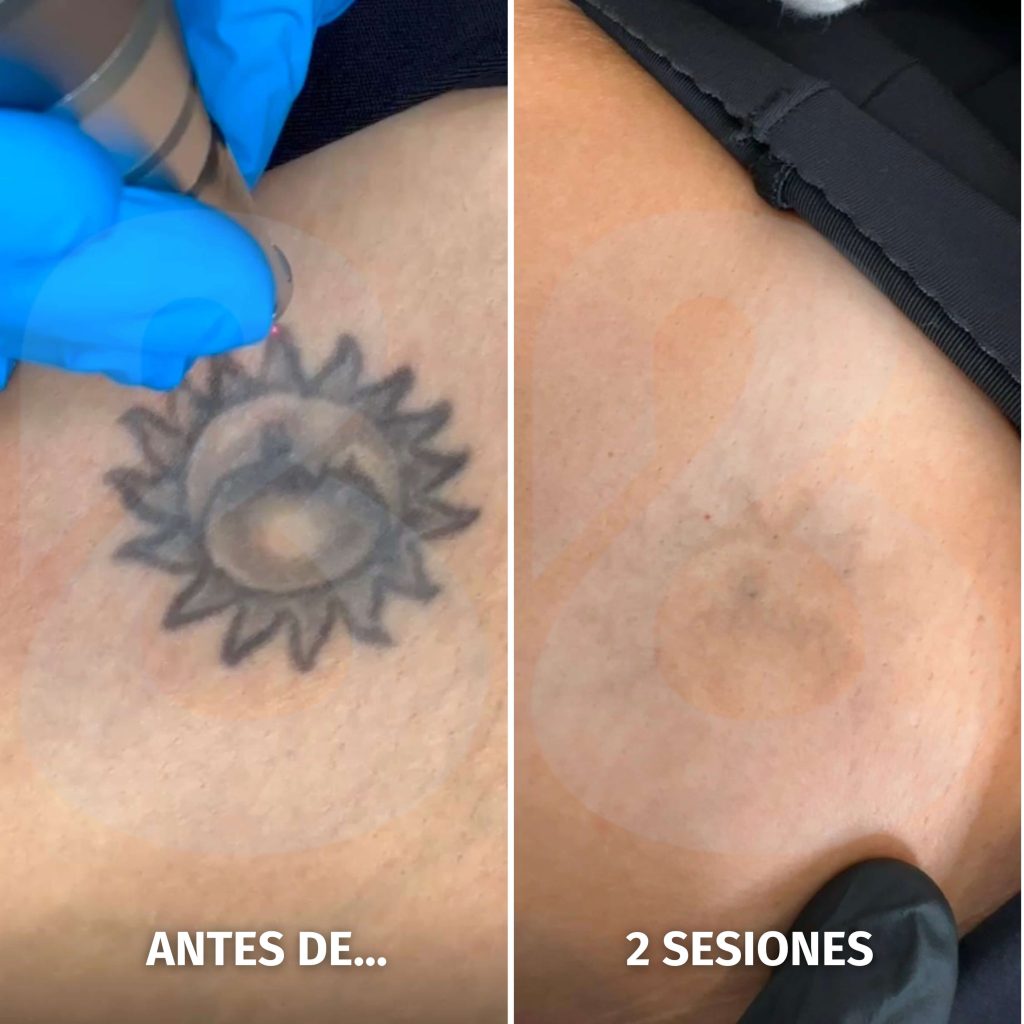 Imagen de procedimiento de eliminación de tatuaje