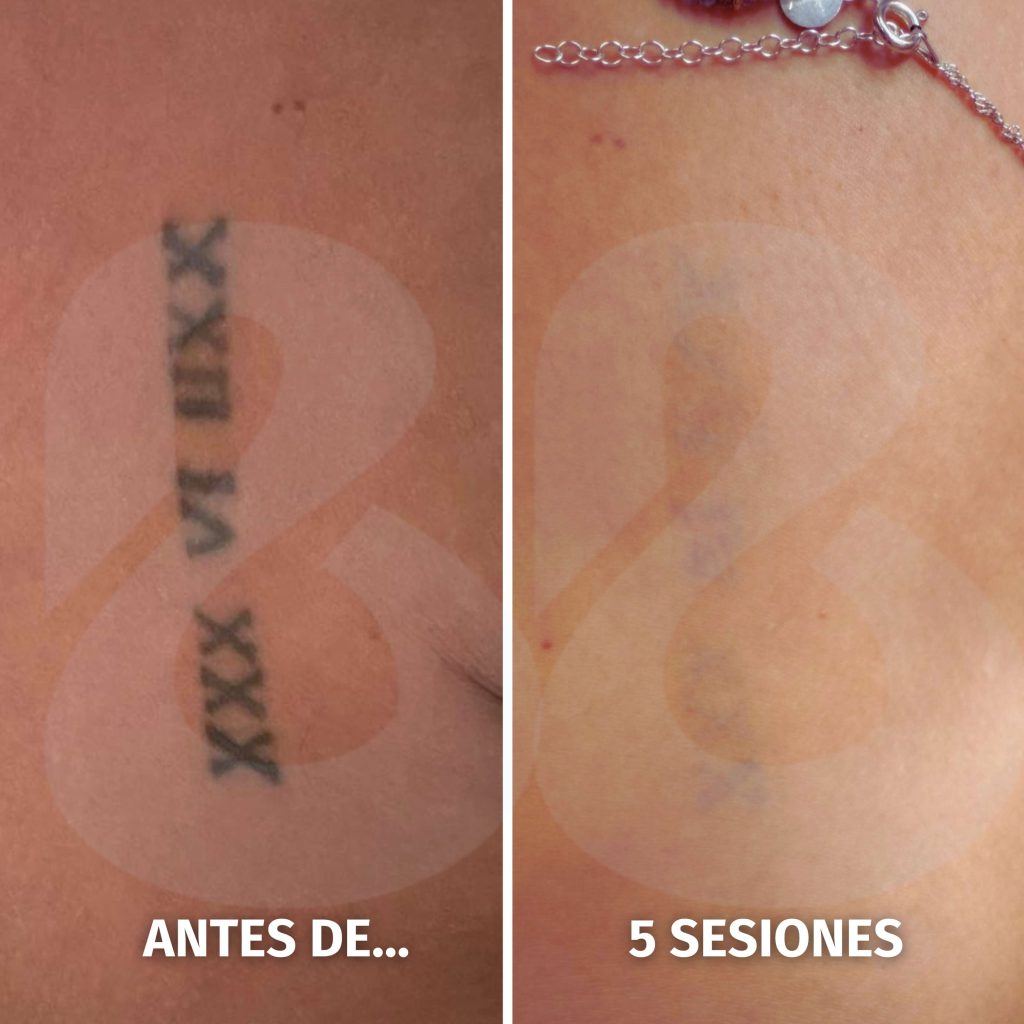 Eliminación de tatuaje en Benilaser, Benidorm