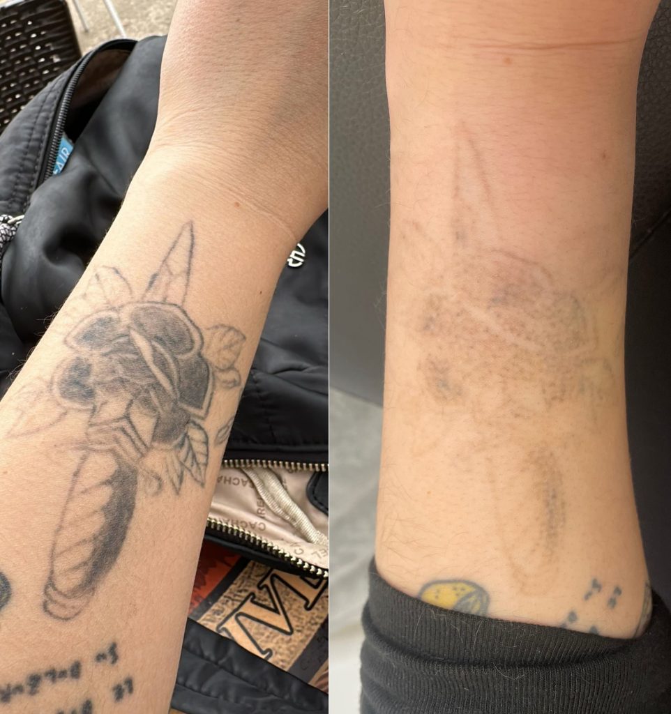 Imagen que explica las sesiones requeridas para aclarar un cover up